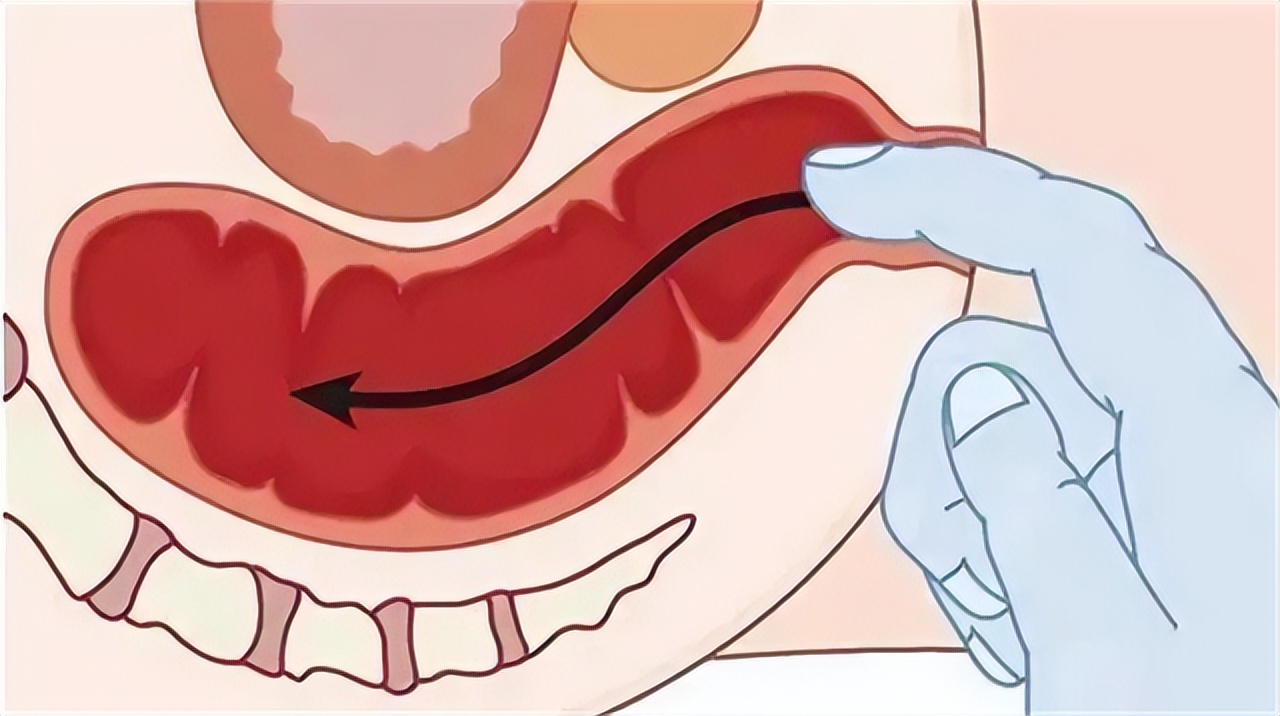总感觉大便拉不干净，这是怎么回事？医生提醒：留意这3种病