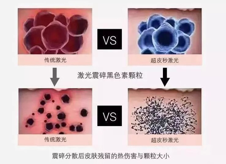皮秒祛斑个人经历,轻医美祛斑怎么做的