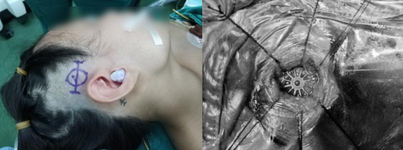 脑科手术难保秀发？医生从约1.3cm的骨孔实施手术