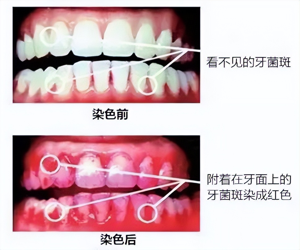 飞利浦牙刷和小米牙刷有什么区别,飞利浦电动牙刷推荐评测2023