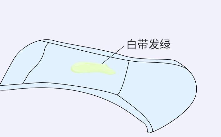 女人出现豆腐渣白带，可能提示身体出了问题