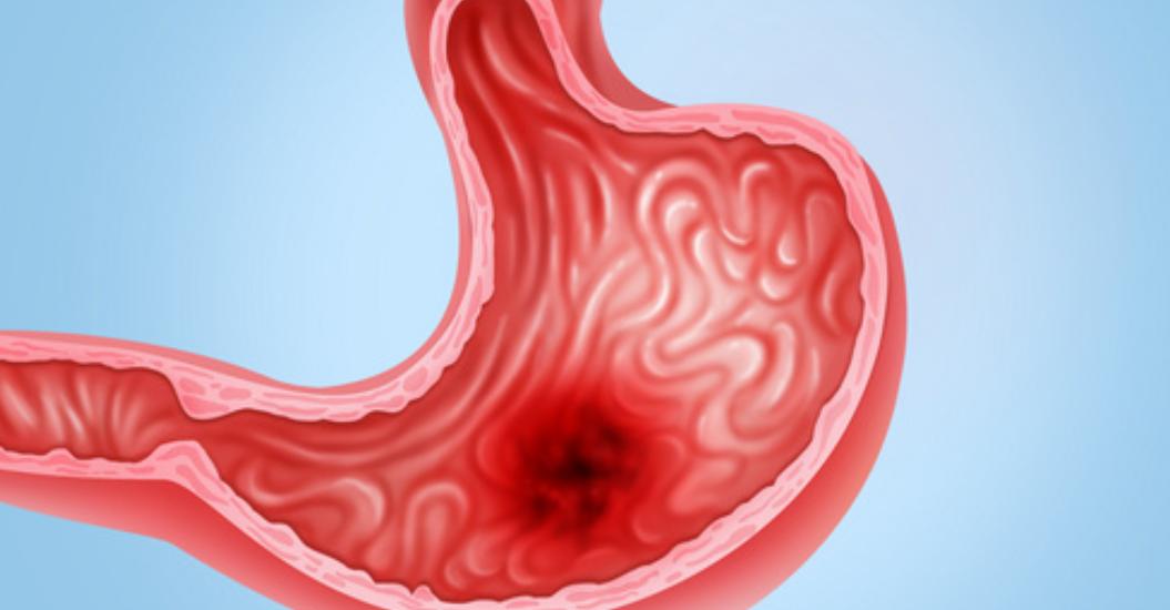 胃溃疡反复发作如何治疗,胃溃疡治好后如何保养