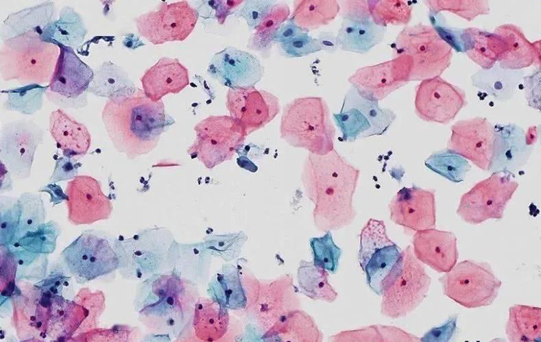 宫颈癌几期会腰疼,宫颈癌拖三个月会怎样