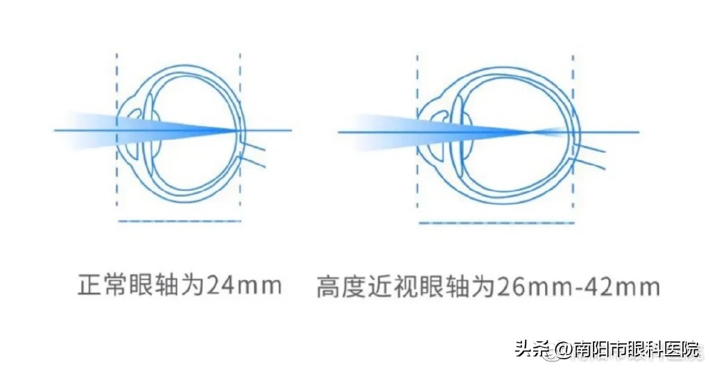 近视长期不戴眼镜会加深近视吗,近视不戴眼镜怎么解决近视