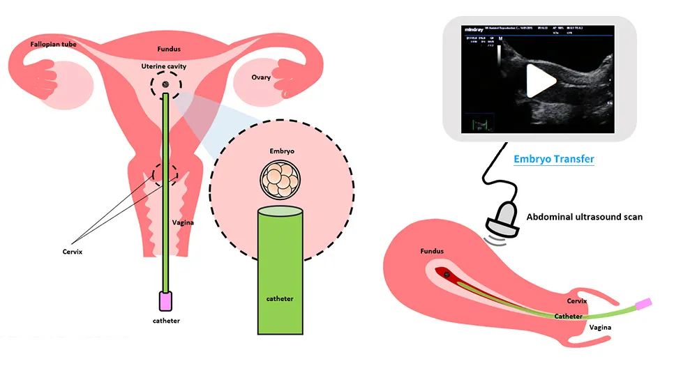 胚胎移植后需要这样保胎！