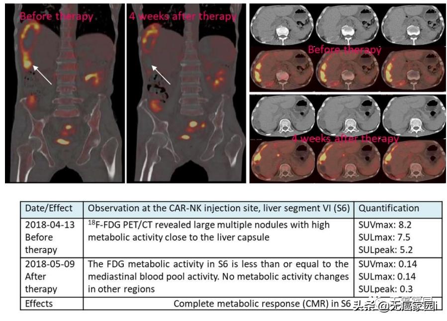肝癌nk细胞免疫治疗,nk细胞治疗肿瘤最好的专家