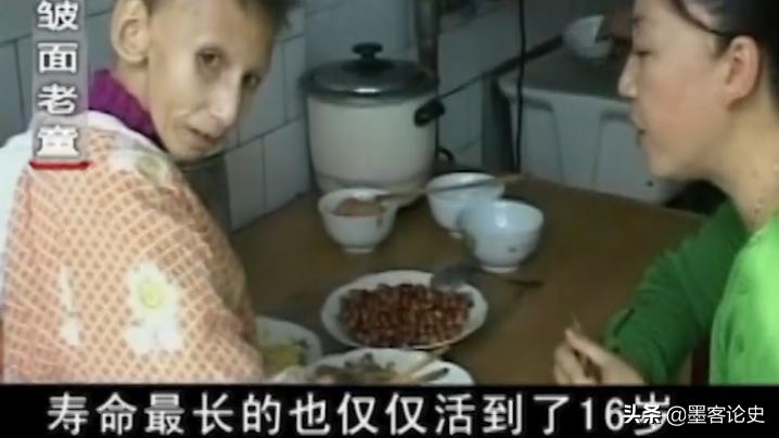 故事:河南1岁女婴患早老症,一夜变成80岁老人,母亲含泪千里求医