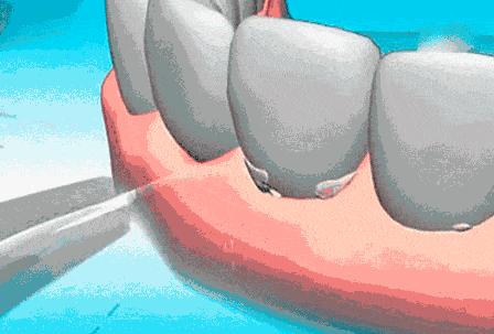 洗牙为什么特别难受,为什么洗牙感觉这么疼
