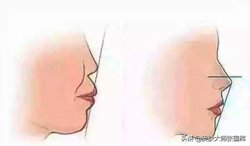 法令纹显老10岁试试这个新办法,法令纹这么显老得如何搞定