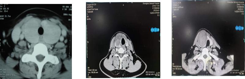世界甲状腺知识宣传周宣传视频,世界卫生组织甲状腺结节