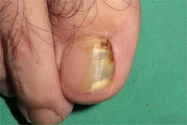 甲癣不严重怎么治疗,甲易生治疗灰指甲吗