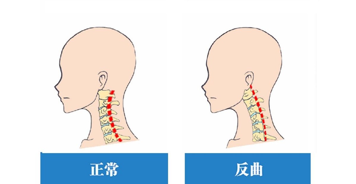 颈椎曲度反曲引起头痛,确诊颈椎反曲能看中医按摩吗