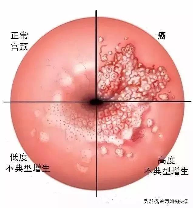 女性宫颈癌白带症状,哪些女性容易得宫颈癌