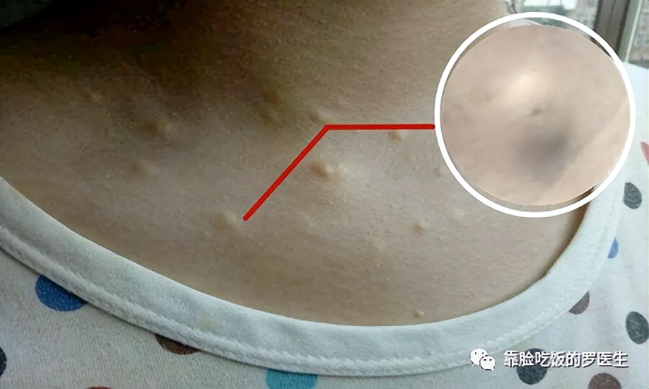 脸上的痣带毛还比较大怎么去除,脸上的痣去掉后长了个肉疙瘩