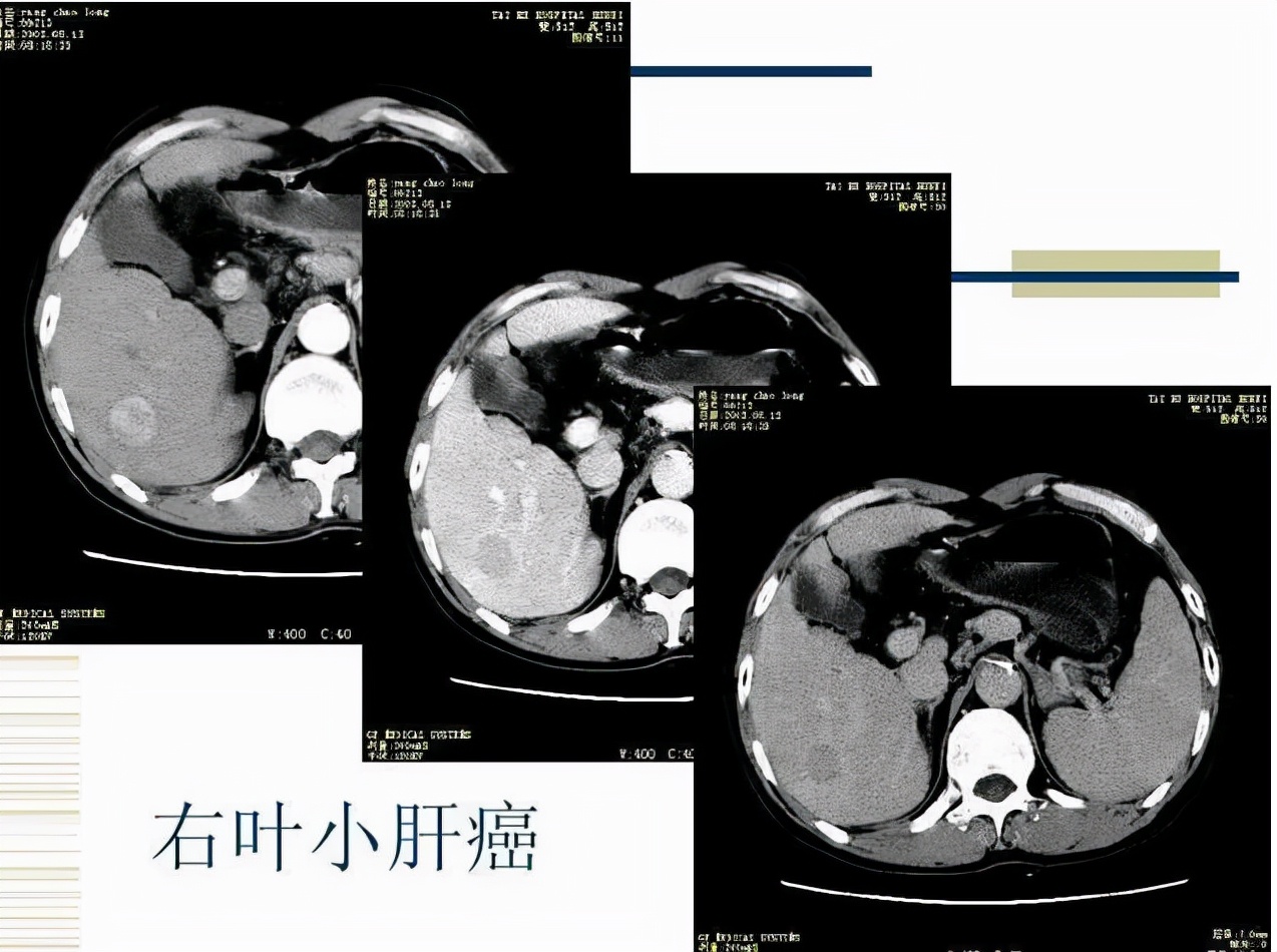 肝脏肿瘤10cm多久生成的,肝脏恶性肿瘤接近10cm怎么治疗