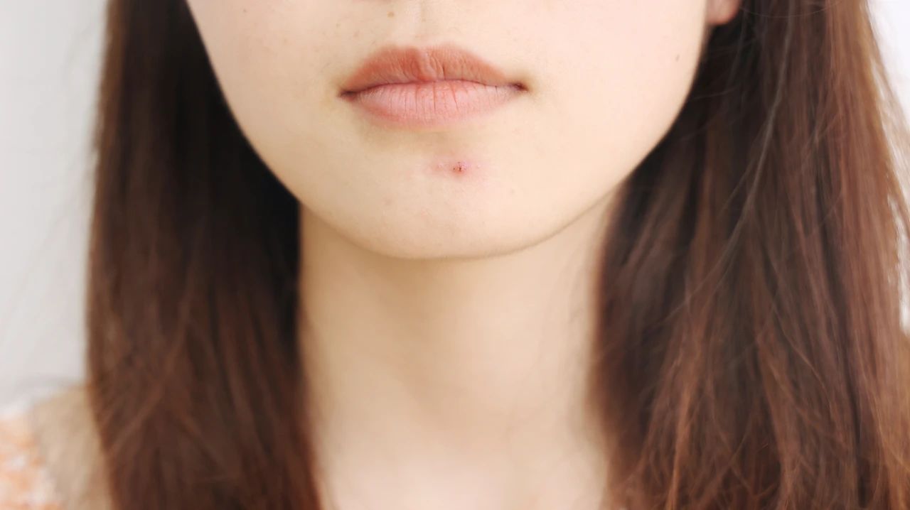 急性荨麻疹一般是什么过敏导致的,急性荨麻疹过敏源一般有哪些