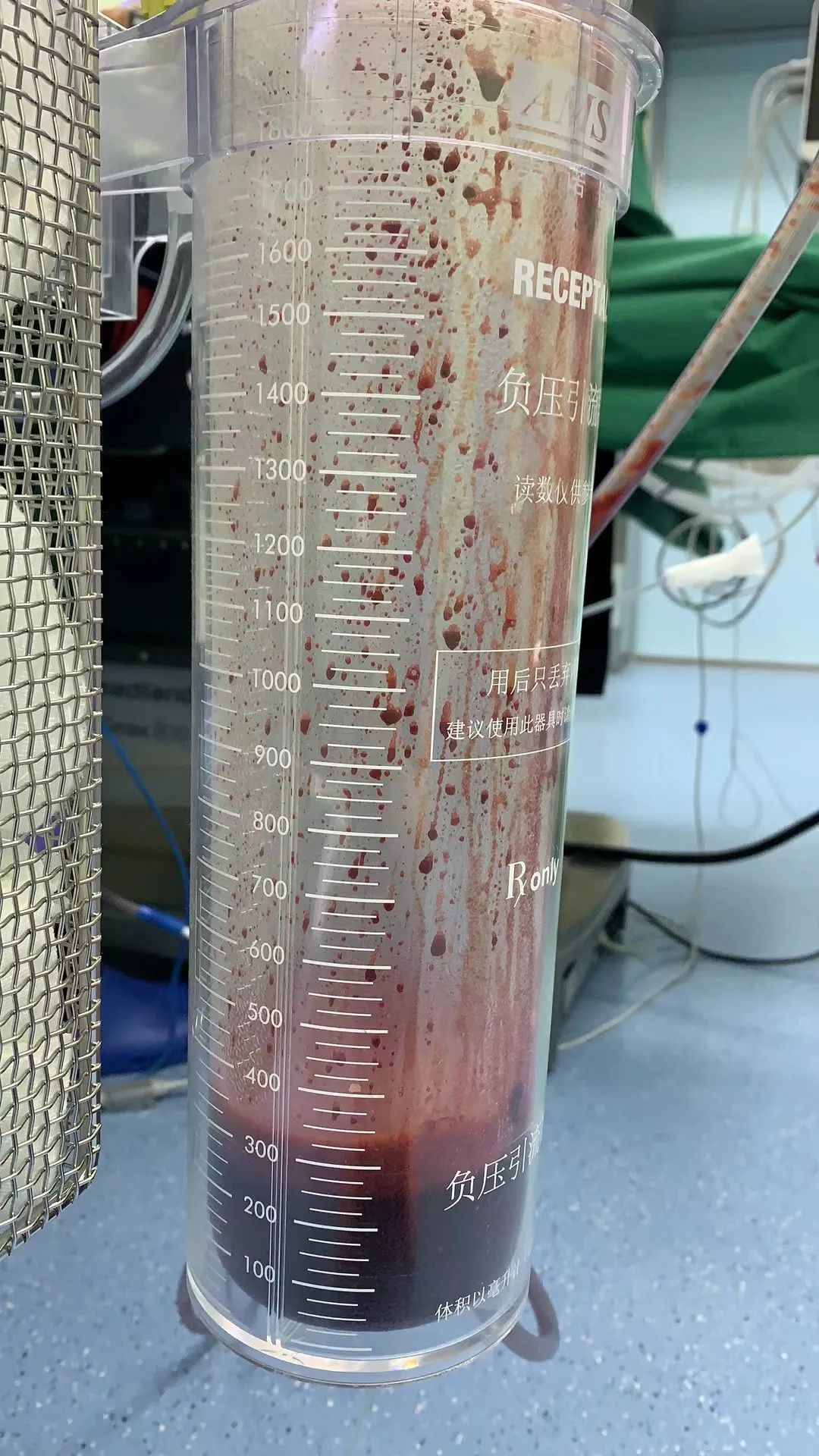 【300ML】上饶11岁少女腹痛排尿受阻，原来是处女膜闭锁惹的祸