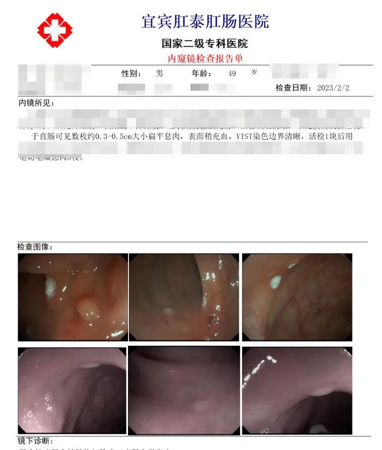 肠镜查出管状腺瘤是怎么回事,肠镜查出管状腺瘤是什么