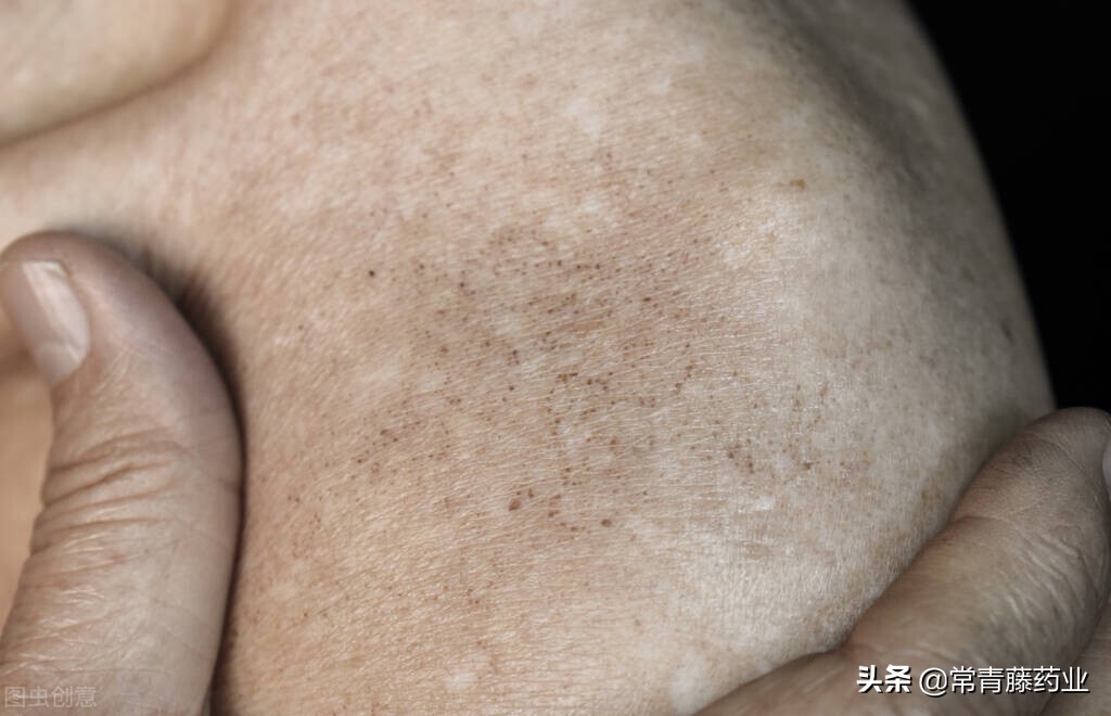 如何分辨晒斑色斑,晒斑与黄褐斑雀斑的区别