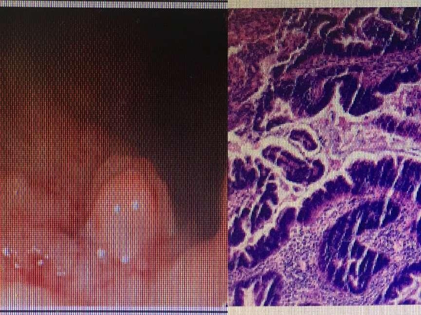 肛门长了个肉赘无症状,痔疮是肉赘还是疙瘩