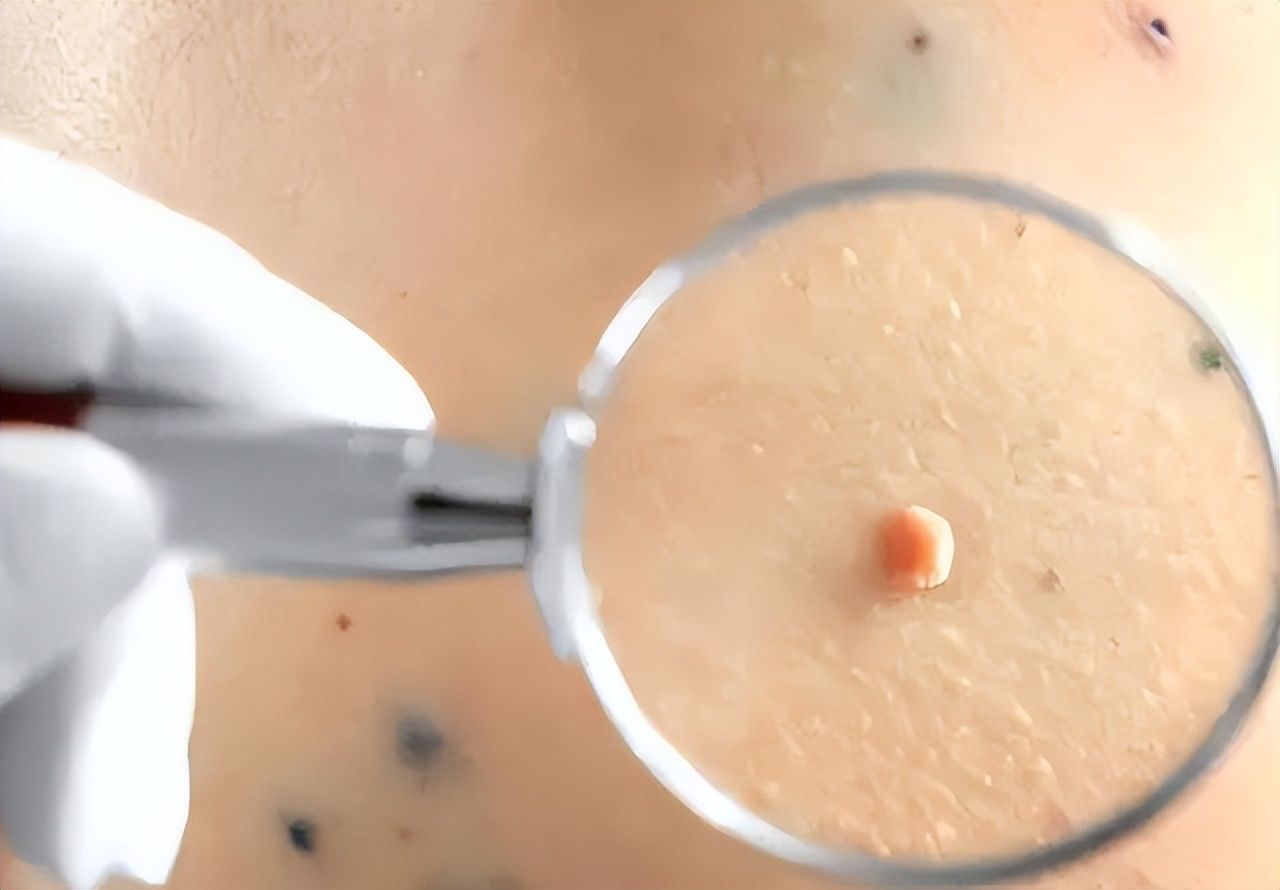 皮肤长“小肉球”是咋回事，可以用手抠掉吗？如何处理？一文看懂