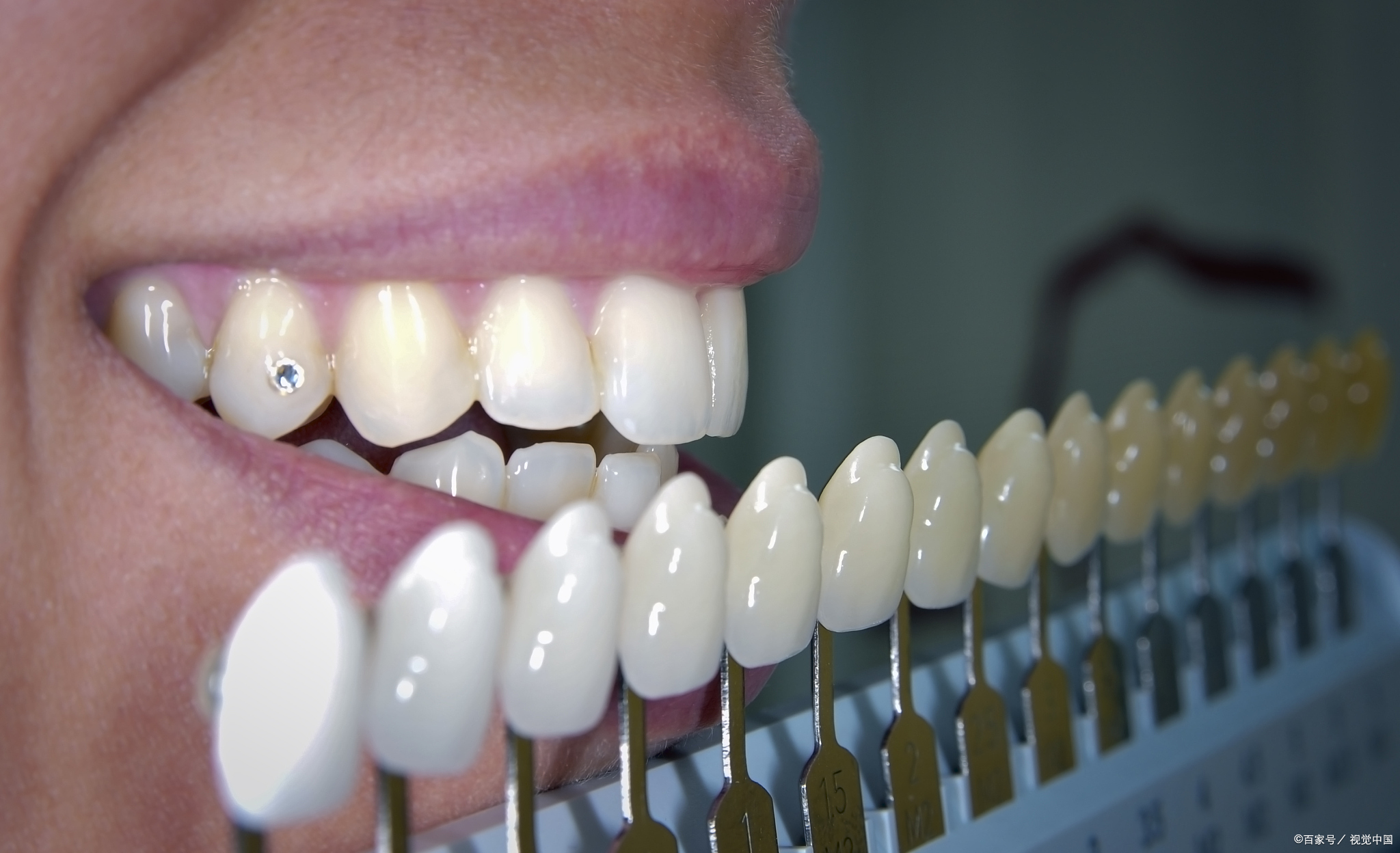 瓷贴面牙齿美白效果怎样,牙贴面美白牙齿让你笑容更自信