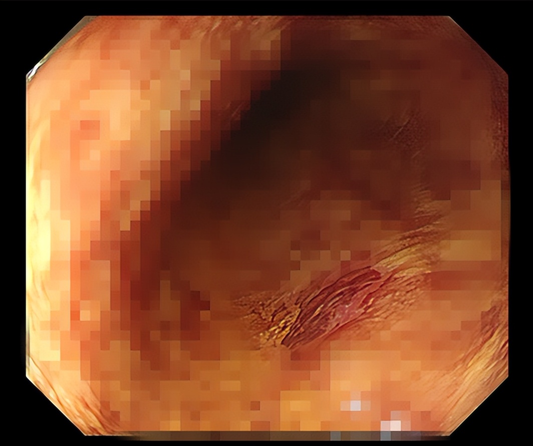 受益于早诊、早治的“幸运儿”