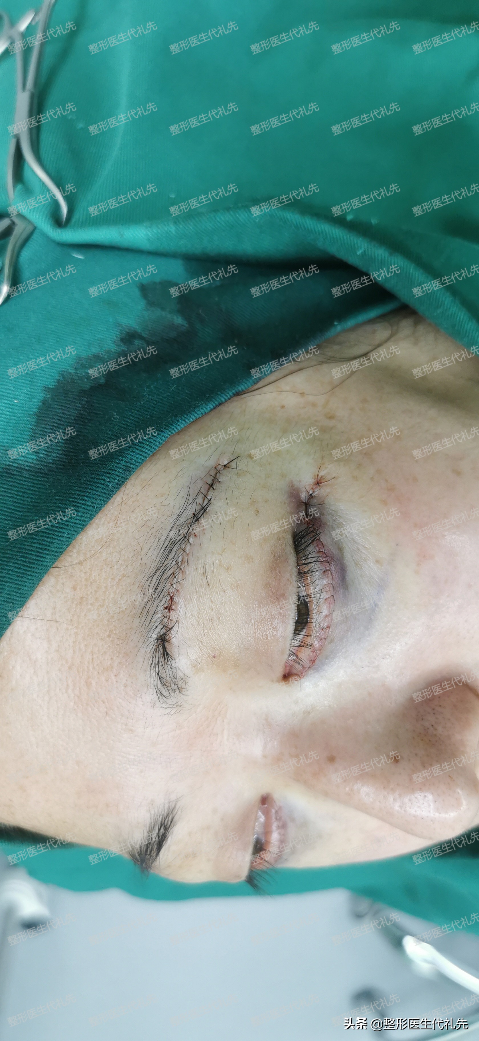 提眉外切眼袋7天后能化妆吗,提眉手术后多久可以做全切眼袋