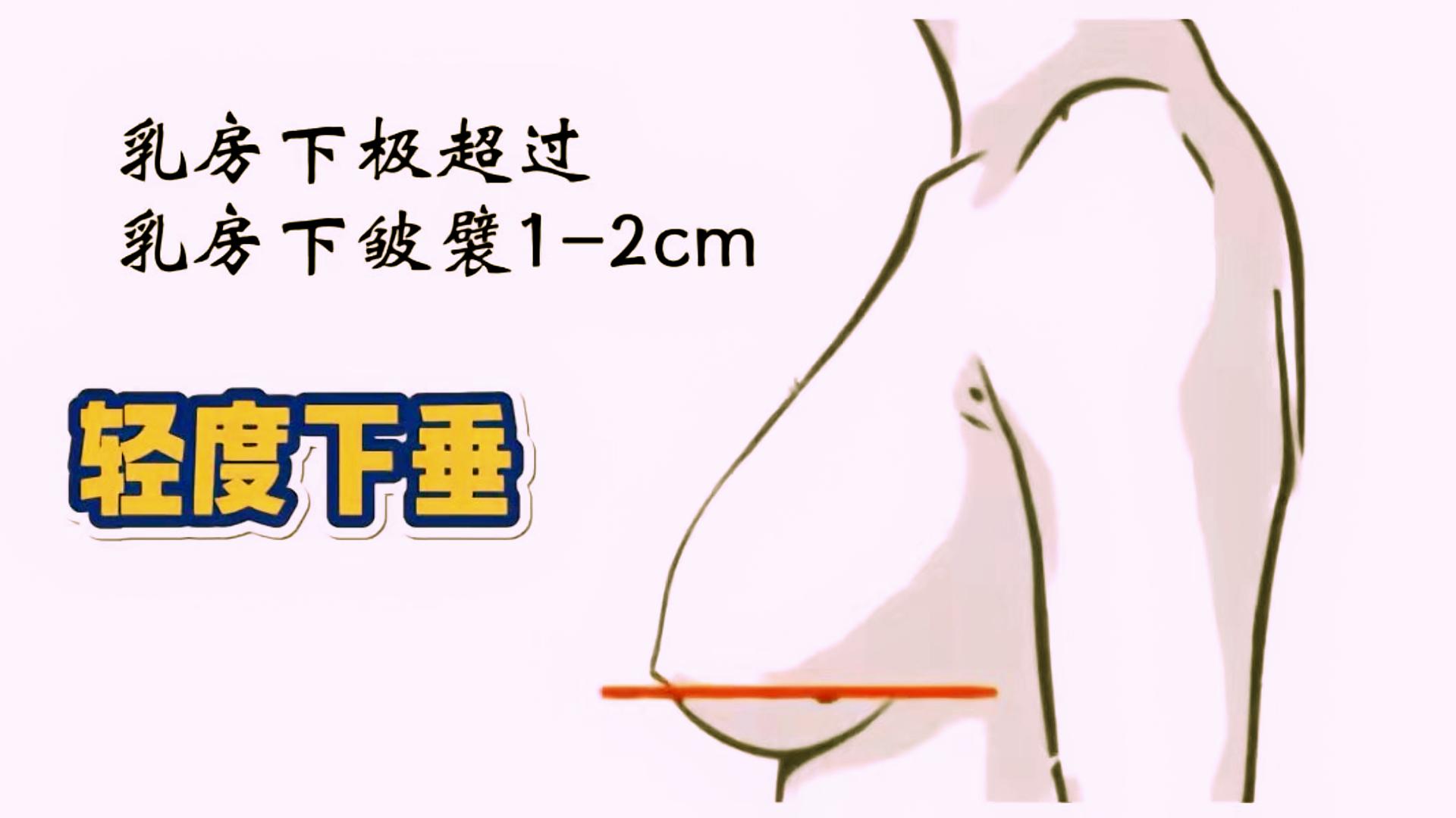 女人胸部下垂大小不一是什么问题,23岁胸部有一点下垂应该怎么办