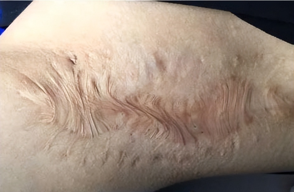 陈旧性的老疤痕该怎么有效修复？