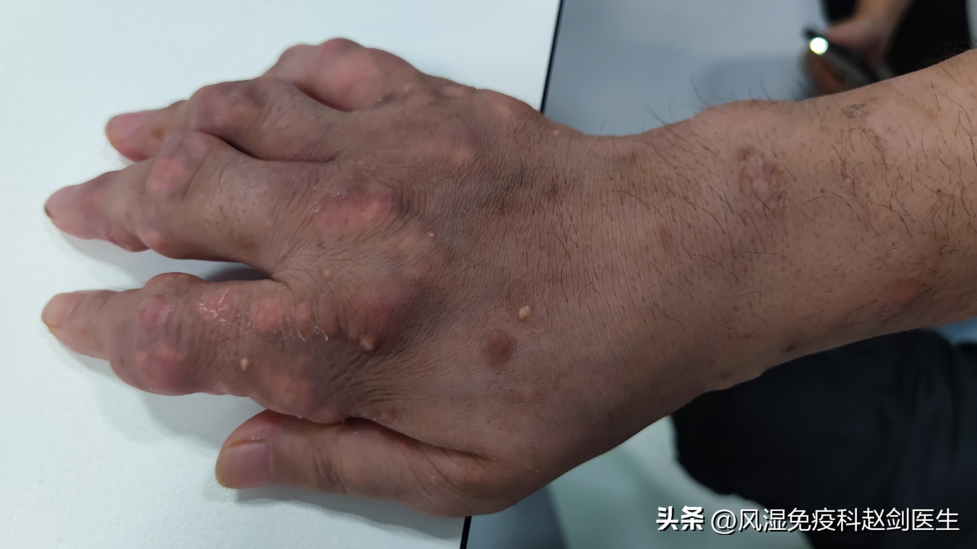 怎样能减少痛风的发作,痛风患者怎样吃可以减少痛风复发