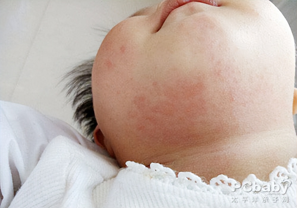 夏天身上总是出汗有没有办法,夏天不出汗冬天出汗是怎么治疗