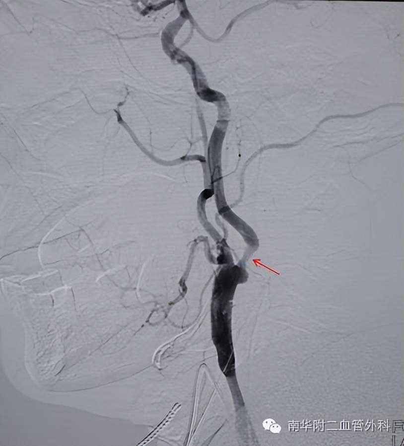 警惕脑卒中隐形杀手颈动脉狭窄,颈动脉闭塞疏通