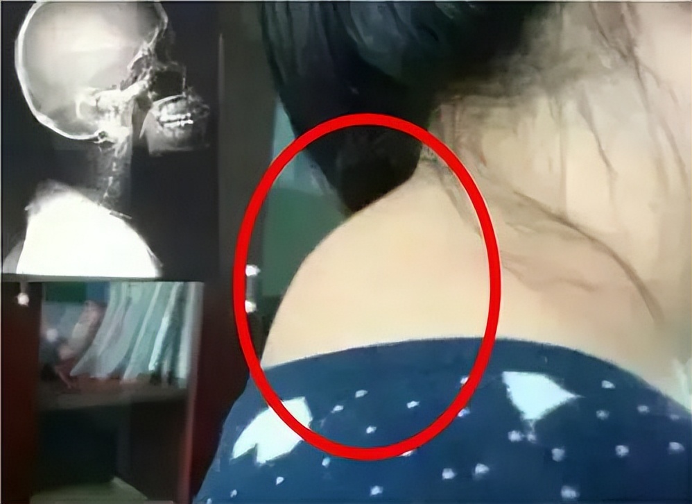 史上最严重的颈椎病,颈椎病到底有多可怕