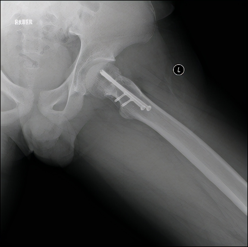 小儿骨科科普类短视频,股骨头骨骺滑脱中医手法治疗
