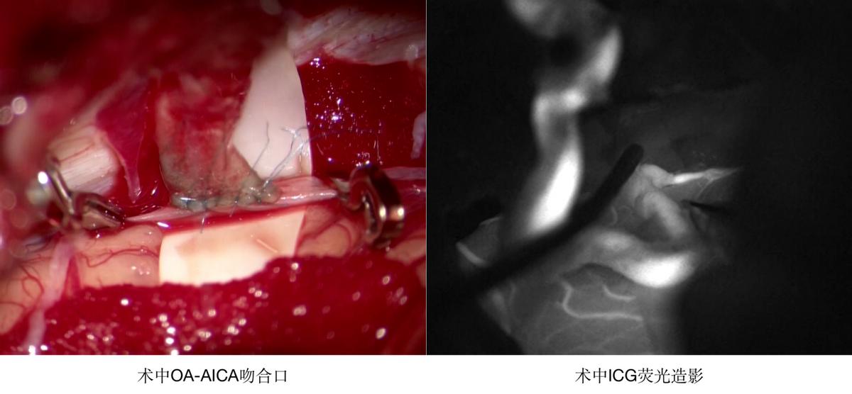 哈尔滨医大一医院脑动脉手术,哈医大一院脑神经外科