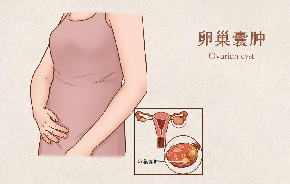 卵巢囊肿怎么治才能不影响生育,卵巢巧克力囊肿癌变的10个征兆