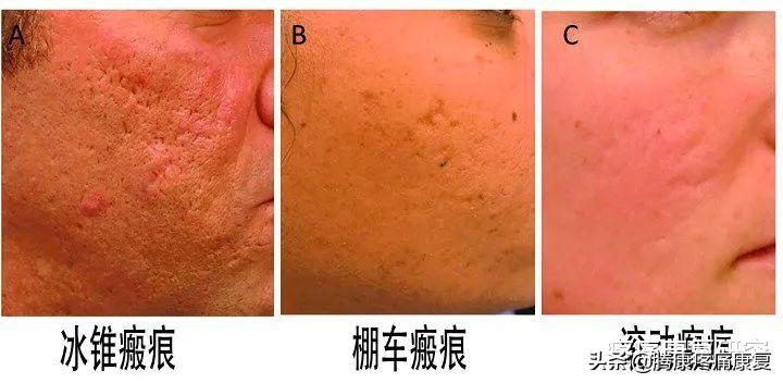 疮疗的后遗症怎么治疗,痤疮留下的瘢痕疙瘩