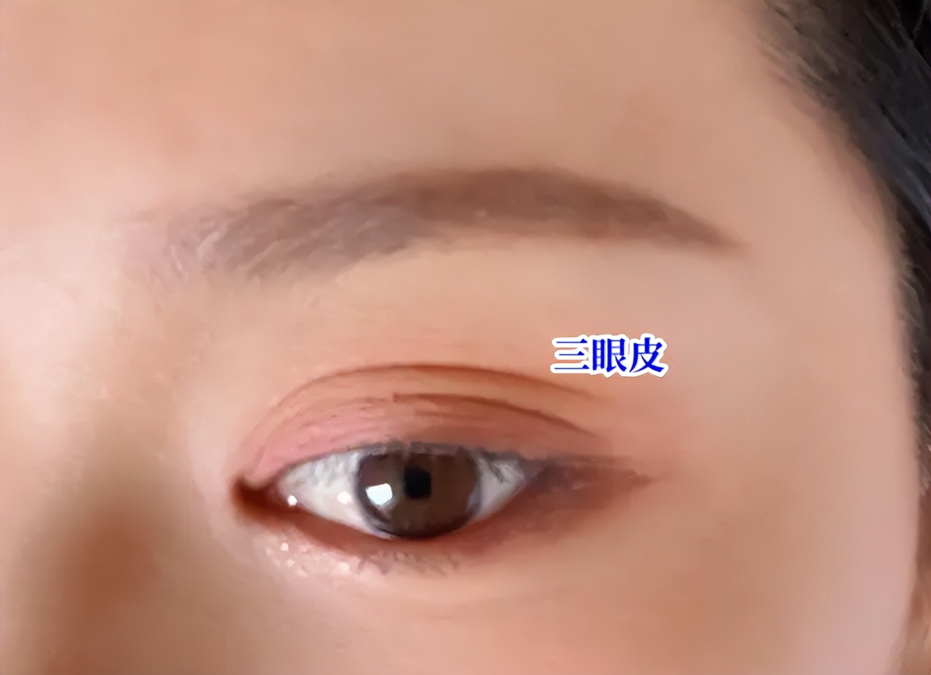 双眼皮变成三眼皮有什么寓意,双眼皮为什么会变成三层