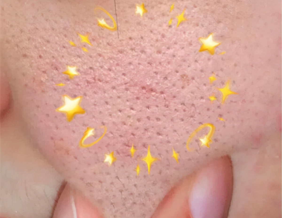 脸上毛孔粗大和遗传有关系吗,遗传性毛孔粗大怎么改善