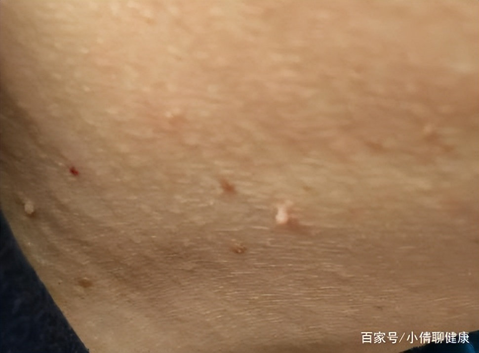 脖子腋下的小肉粒是什么,脖子上肉粒可以自己揪掉么