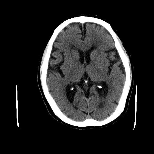 帕金森被误诊视频完整版,被误诊的帕金森