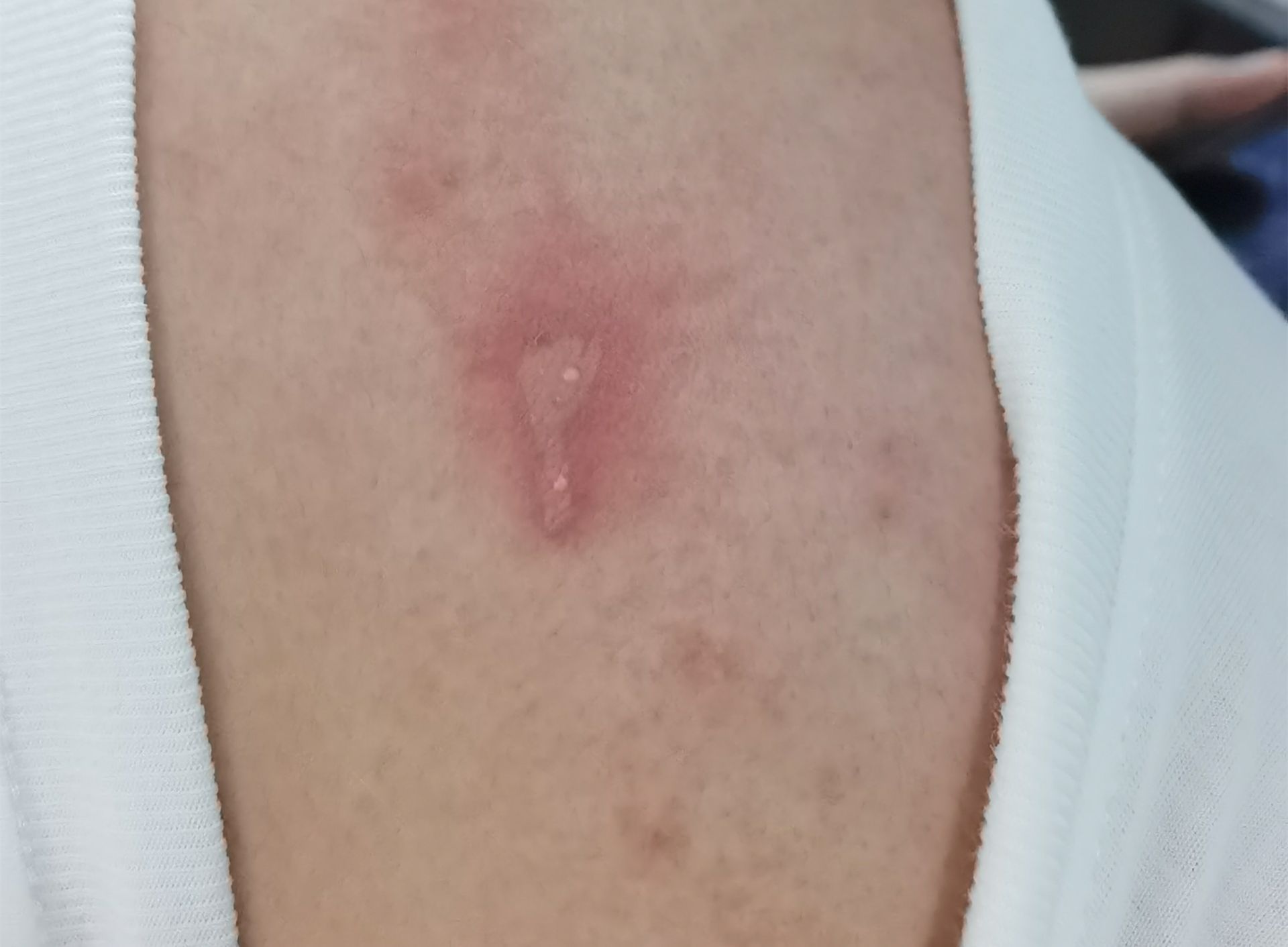 隐翅虫安全知识,当心隐翅虫