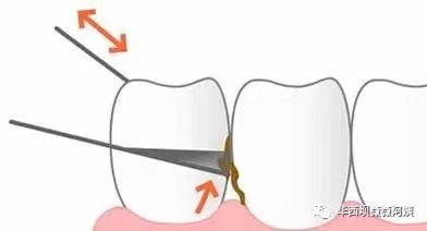 牙科医生儿童牙刷怎么选,矫正牙齿牙刷儿童推荐
