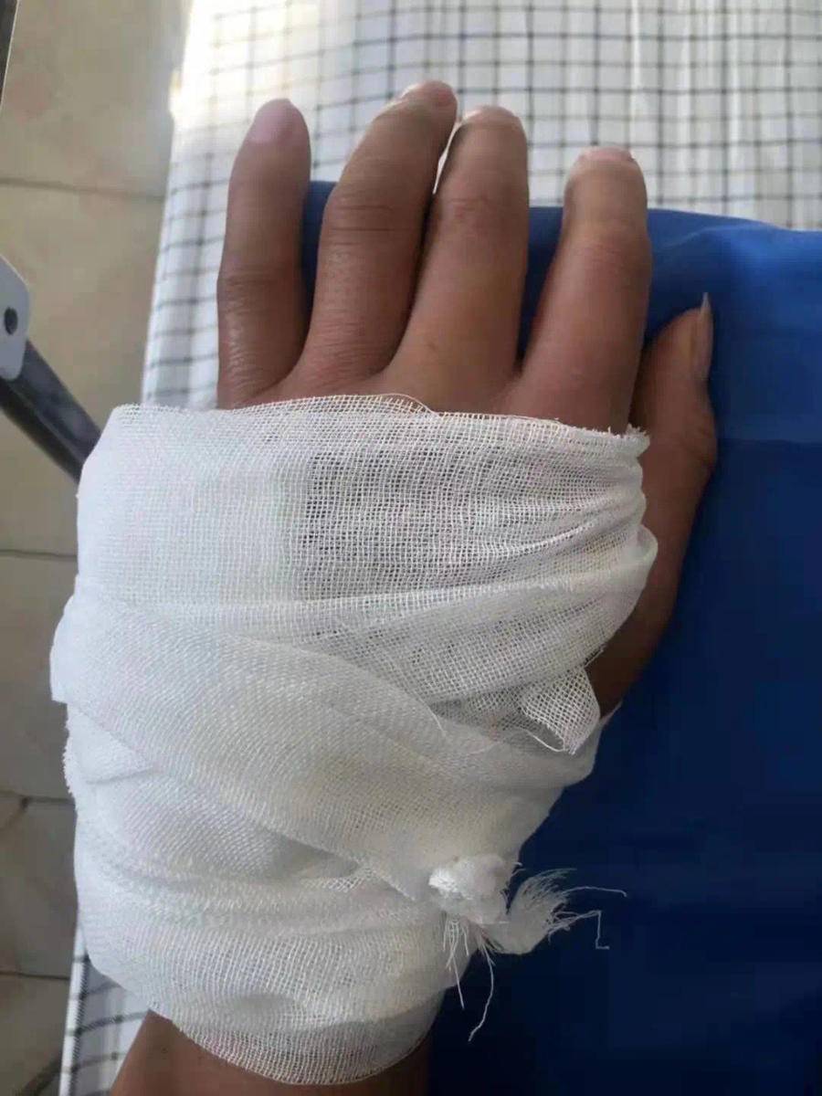 掌骨断了,嫌疑人也没脱出他的手