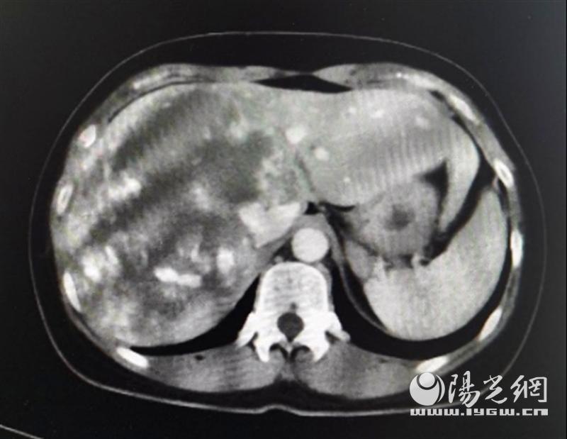 交大一附院肿瘤手术,交大一附院肝血管瘤腹腔镜手术