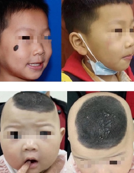 6毫米大的痣用什么方法去除,面部黑痣越来越大怎么办