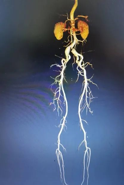 髂动脉支架植入视频,髂动脉夹层支架植入视频