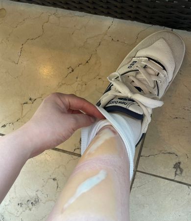 女演员意外出血痛苦,女歌手意外受伤身亡