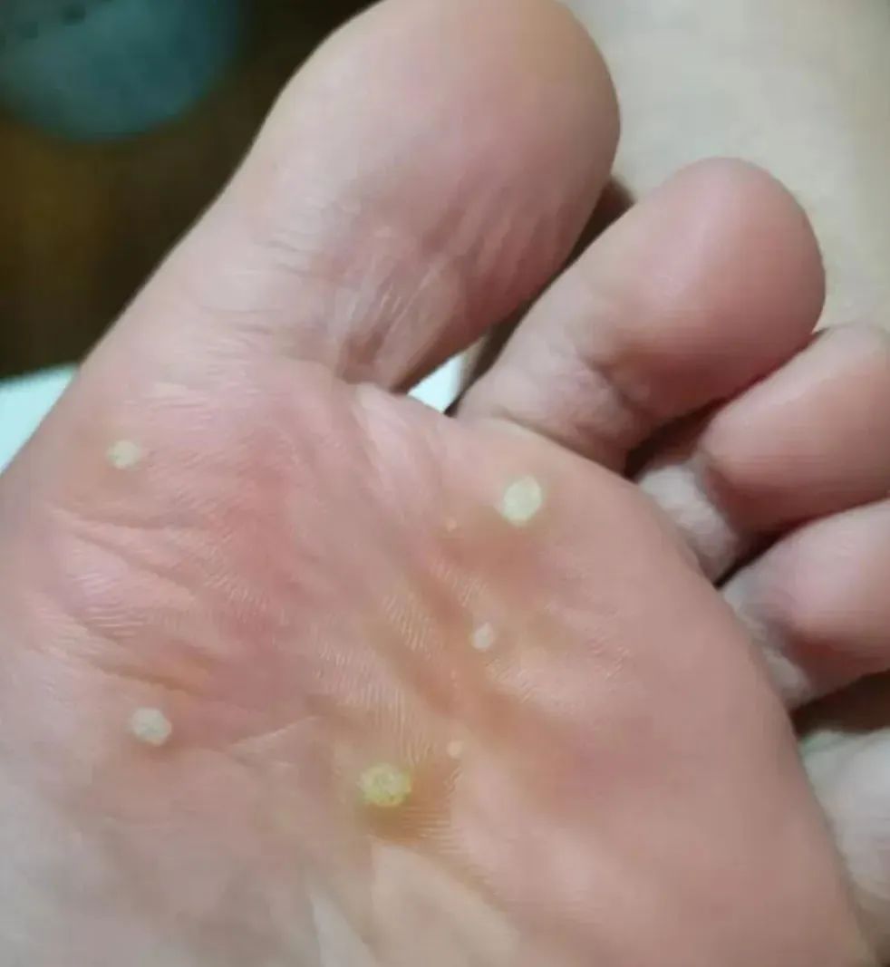 10岁男孩游泳班感染hpv,浙江一小男孩上游泳课感染hpv